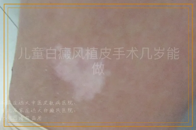 儿童白癜风植皮手术几岁能做