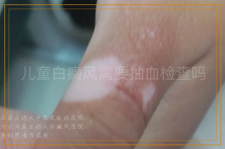 儿童白癜风需要抽血检查吗