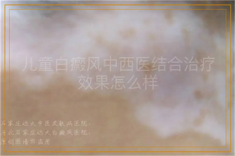 儿童白癜风中西医结合治疗效果怎么样