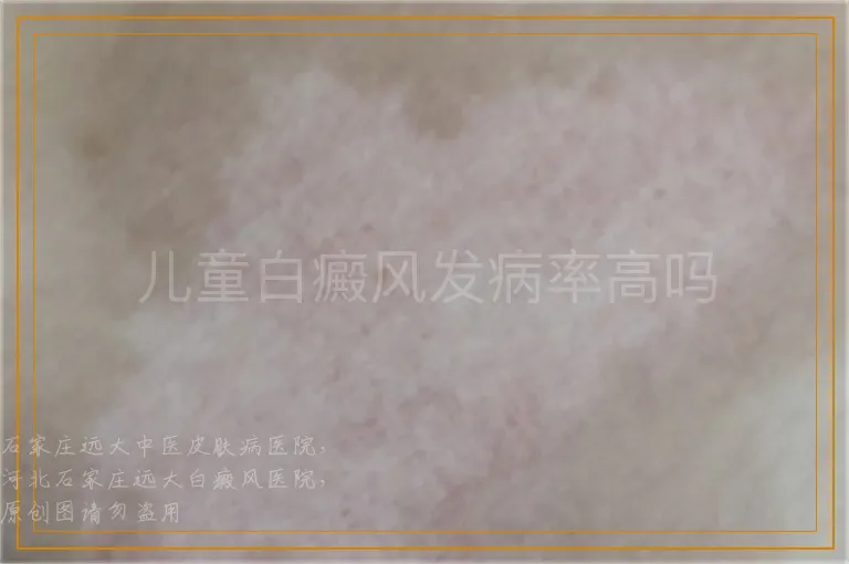 儿童白癜风发病率高吗