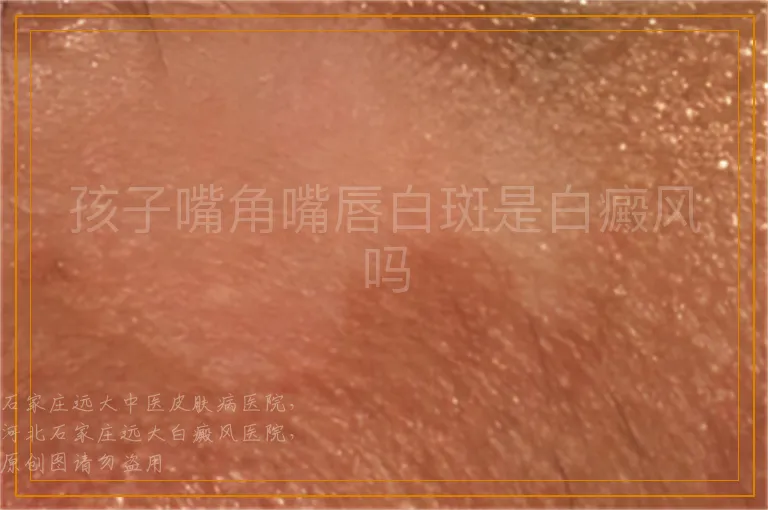 孩子嘴角嘴唇白斑是白癜风吗