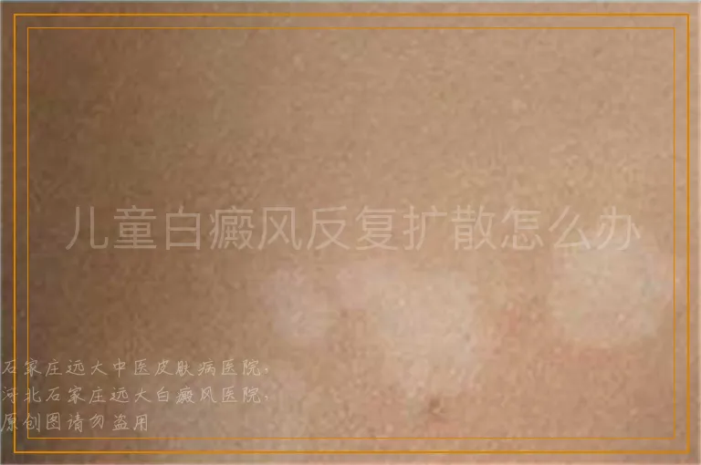 儿童白癜风反复扩散怎么办