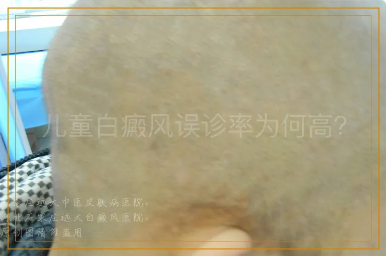 儿童白癜风误诊率为何高？