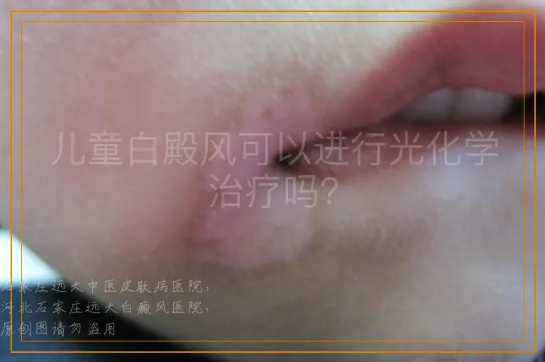 儿童白殿风可以进行光化学治疗吗？
