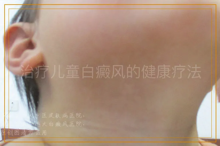 治疗儿童白癜风的健康疗法