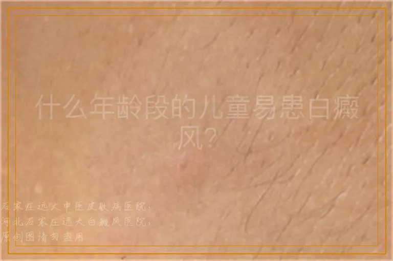 什么年龄段的儿童易患白癜风？