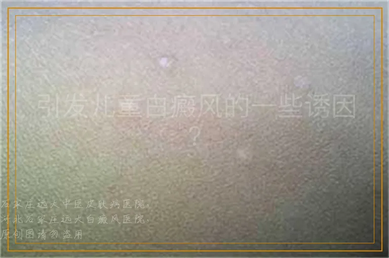 引发儿童白癜风的一些诱因？