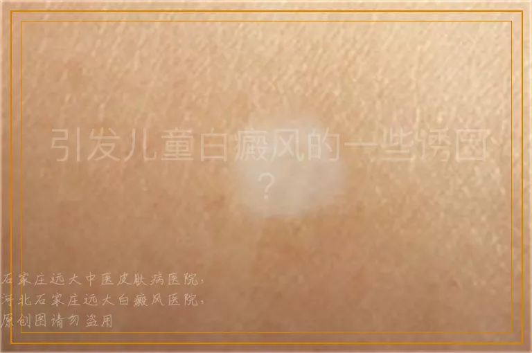 引发儿童白癜风的一些诱因？