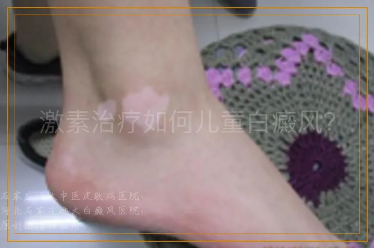 激素治疗如何儿童白癜风？