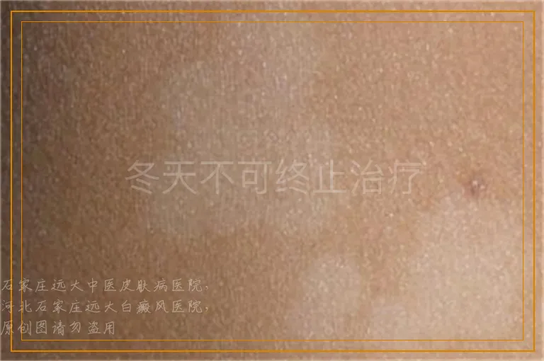 冬天不可终止治疗