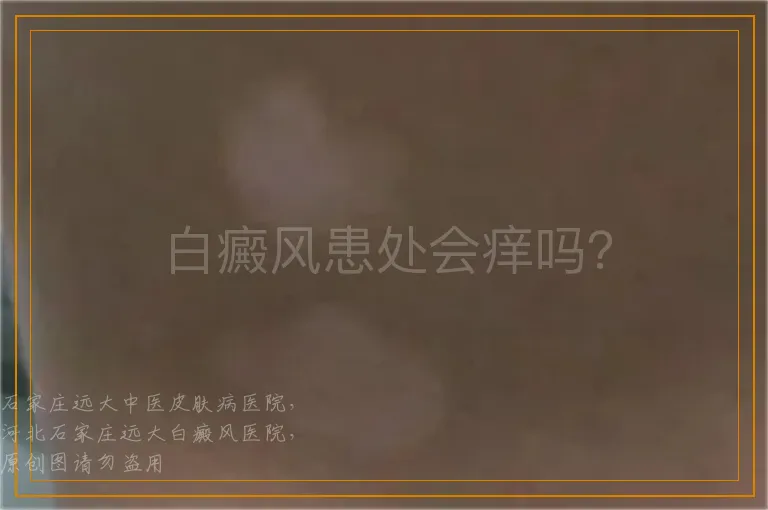 白癜风患处会痒吗？
