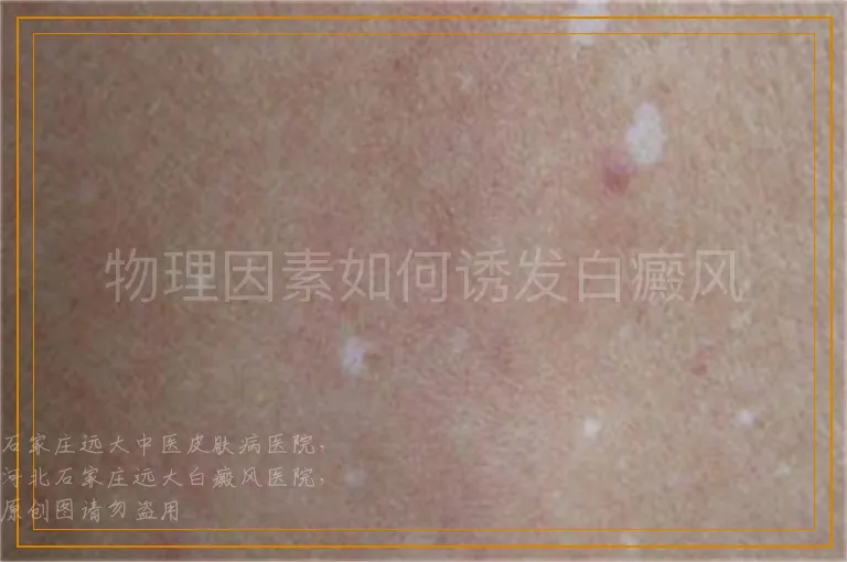 物理因素如何诱发白癜风