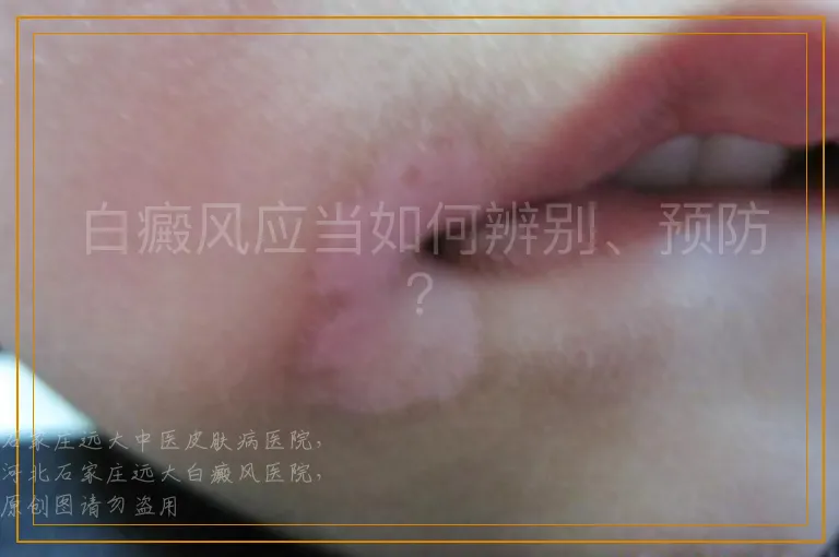 白癜风应当如何辨别、预防？
