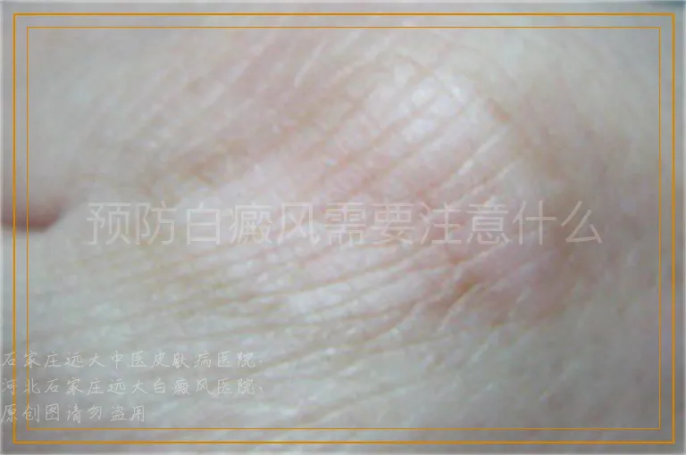 预防白癜风需要注意什么