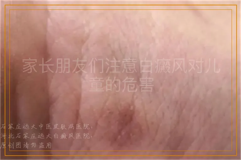 家长朋友们注意白癜风对儿童的危害