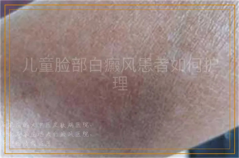 儿童脸部白癜风患者如何护理