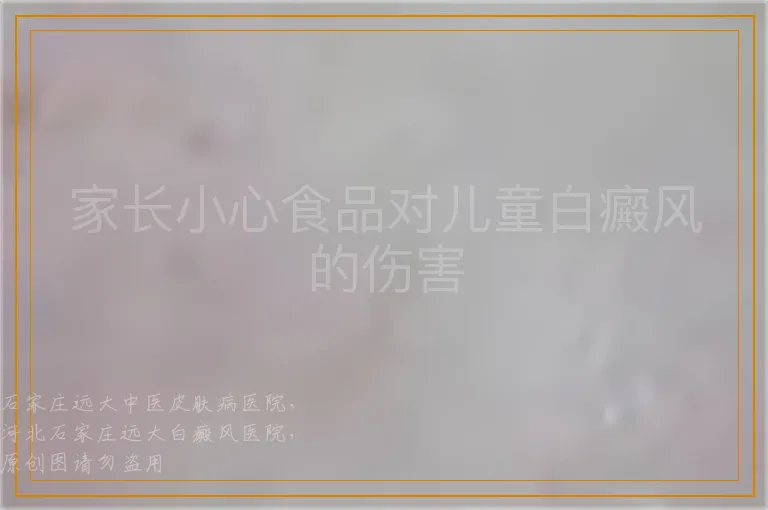 家长小心食品对儿童白癜风的伤害