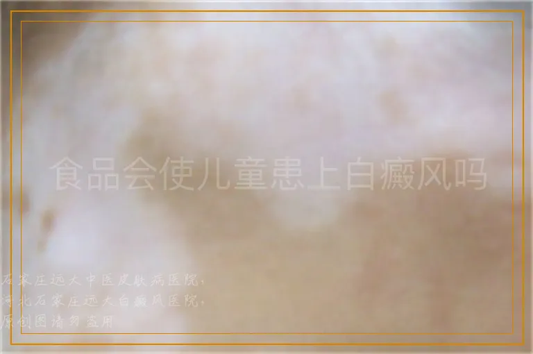 食品会使儿童患上白癜风吗