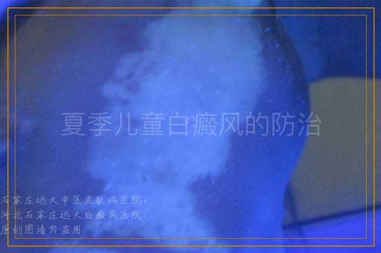 夏季儿童白癜风的防治