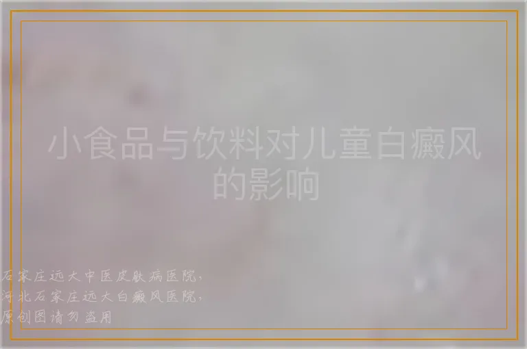 小食品与饮料对儿童白癜风的影响