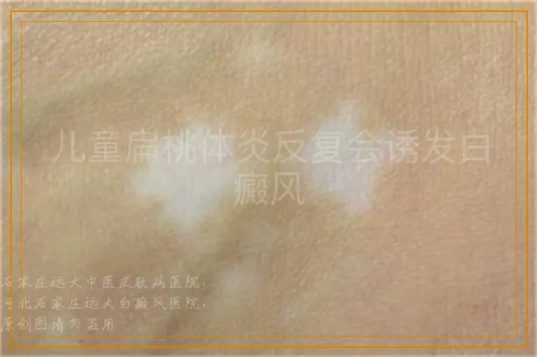 儿童扁桃体炎反复会诱发白癜风