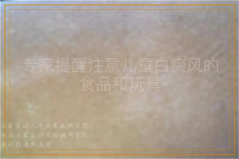 专家提醒注意儿童白癜风的食品和玩具