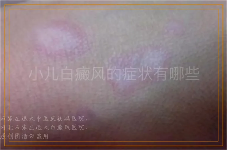 小儿白癜风的症状有哪些