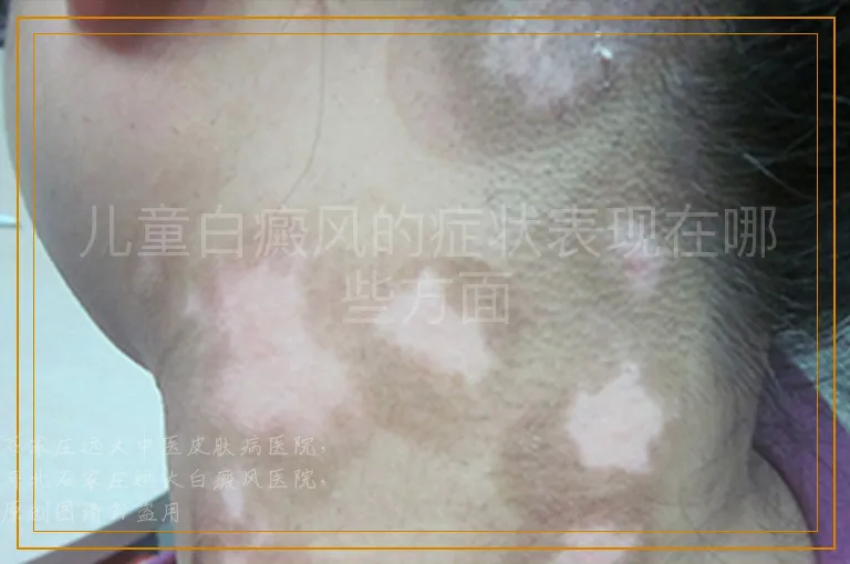 儿童白癜风的症状表现在哪些方面