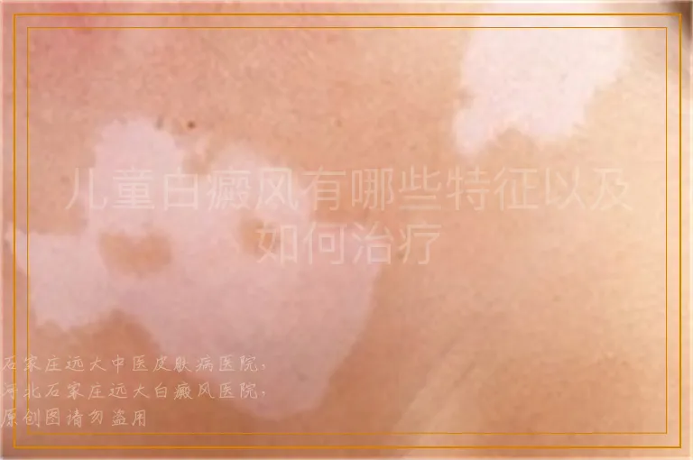 儿童白癜风有哪些特征以及如何治疗