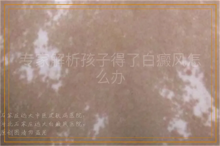 专家解析孩子得了白癜风怎么办