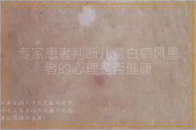 专家患者判断儿童白癜风患者的心理是否健康