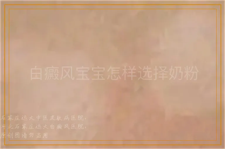 白癜风宝宝怎样选择奶粉