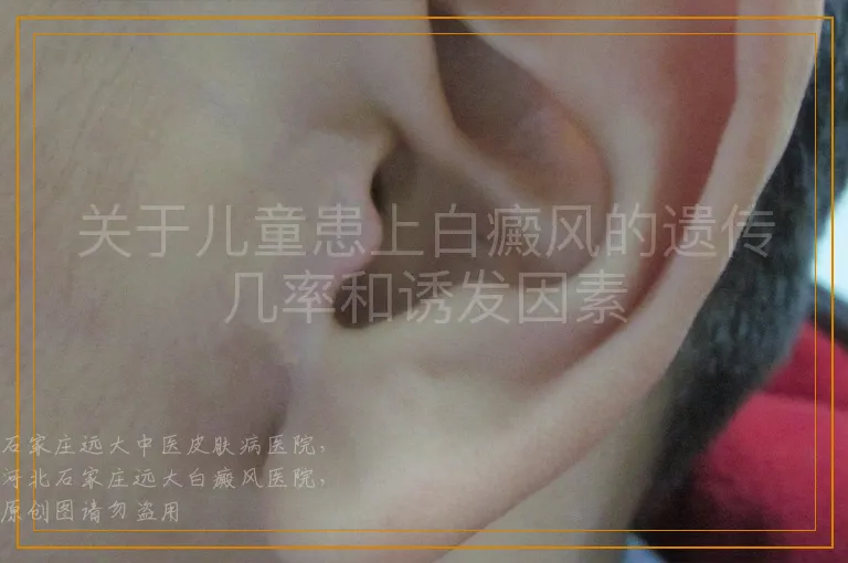 关于儿童患上白癜风的遗传几率和诱发因素