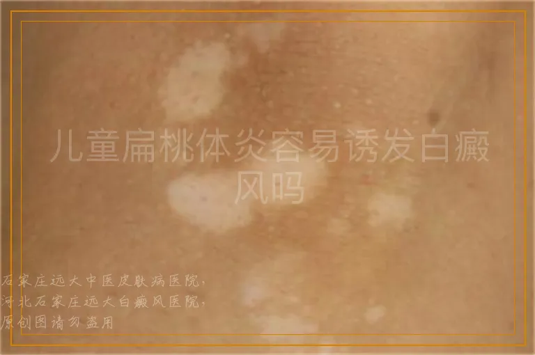 儿童扁桃体炎容易诱发白癜风吗