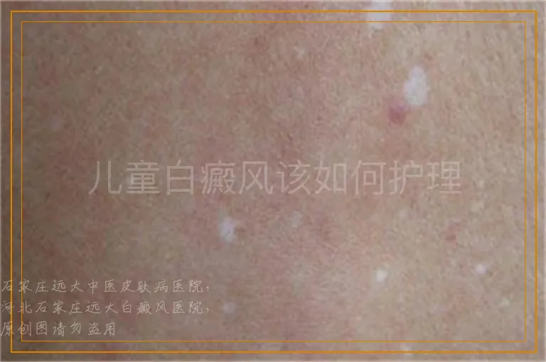 儿童白癜风该如何护理