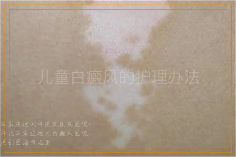 儿童白癜风的护理办法
