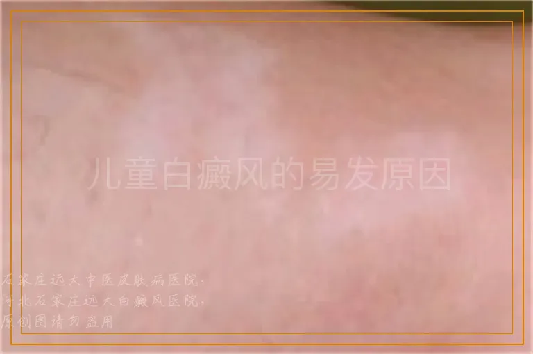 儿童白癜风的易发原因