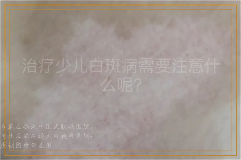 治疗少儿白斑病需要注意什么呢?