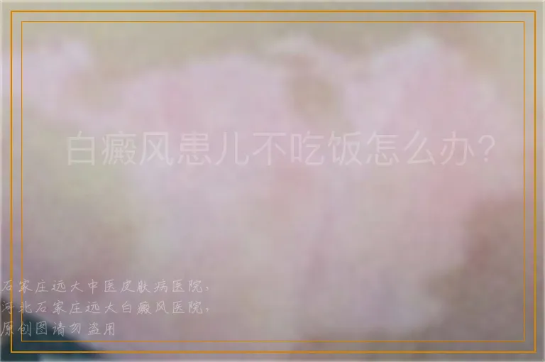  白癜风患儿不吃饭怎么办?