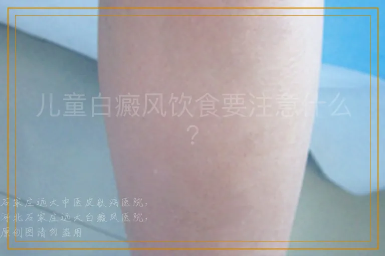 儿童白癜风饮食要注意什么？