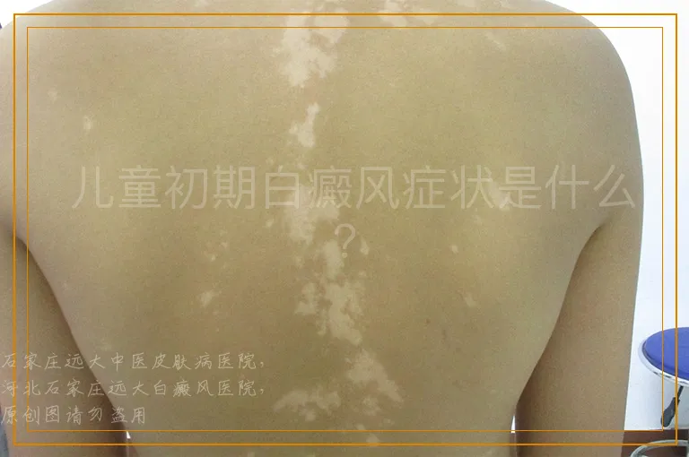  儿童初期白癜风症状是什么？