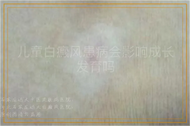 儿童白癜风患病会影响成长发育吗