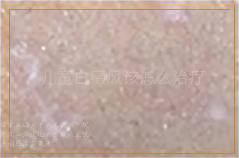  儿童白癜风该怎么治疗