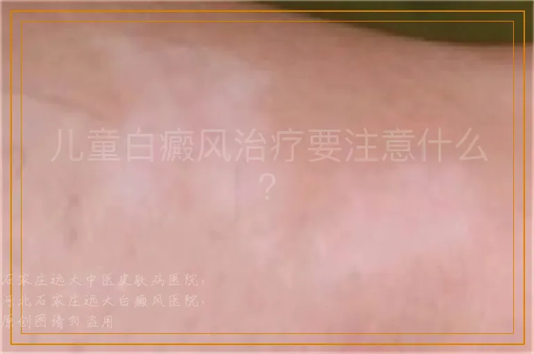 儿童白癜风治疗要注意什么？