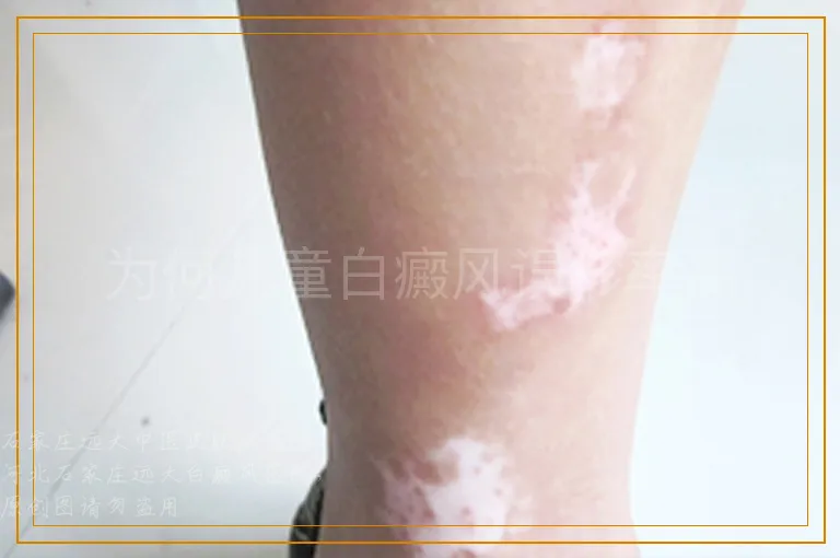为何儿童白癜风误诊率高