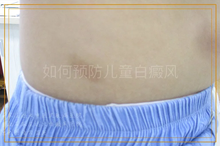 如何预防儿童白癜风