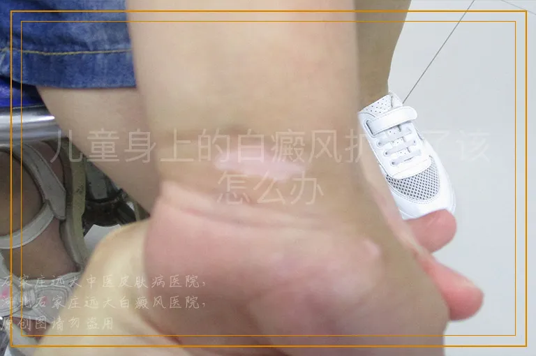 儿童身上的白癜风扩散了该怎么办