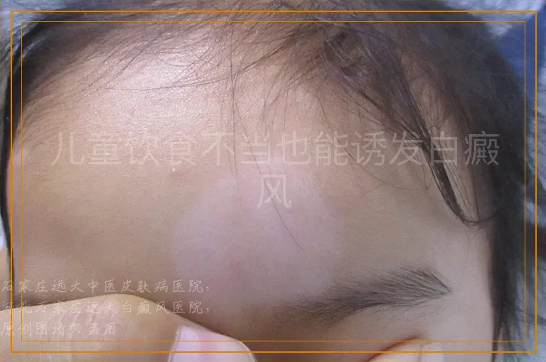 儿童饮食不当也能诱发白癜风
