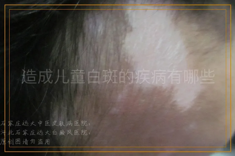 造成儿童白斑的疾病有哪些
