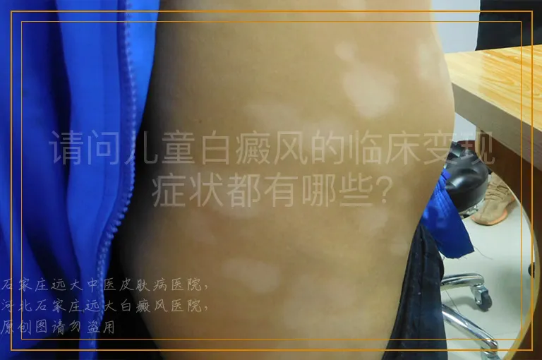 请问儿童白癜风的临床变现症状都有哪些？